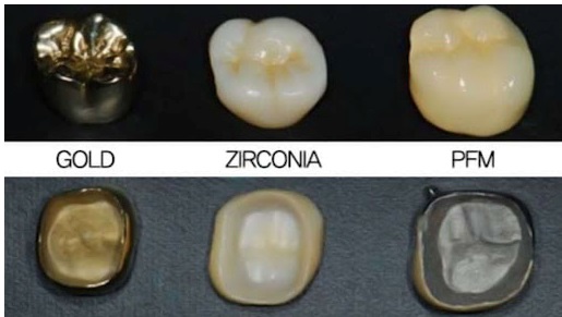 Dental Crown Materials