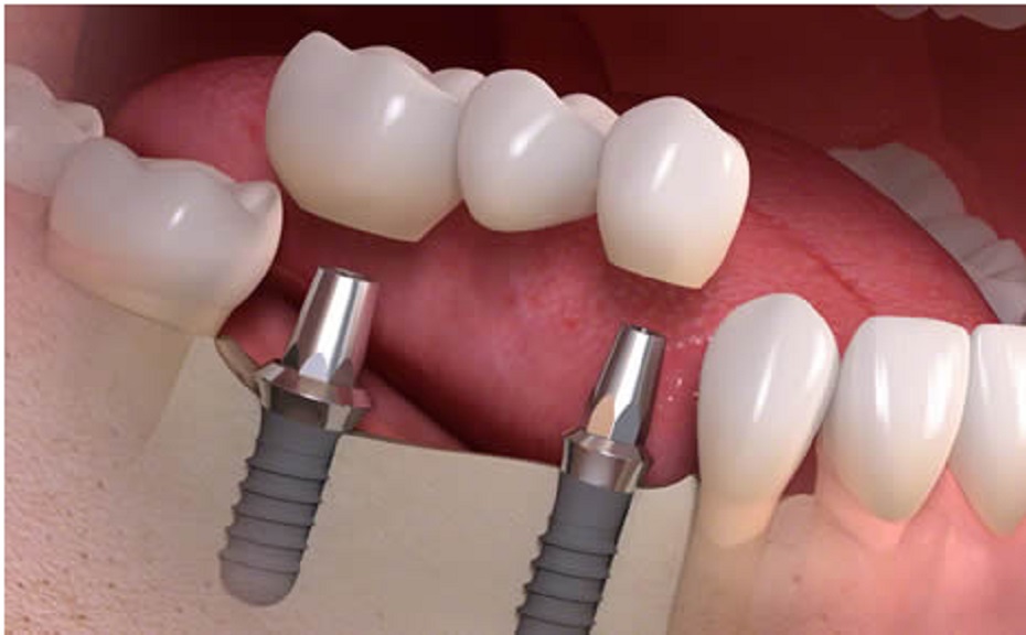 Elevating Tooth Restoration: Merging Dental Crowns with Implants