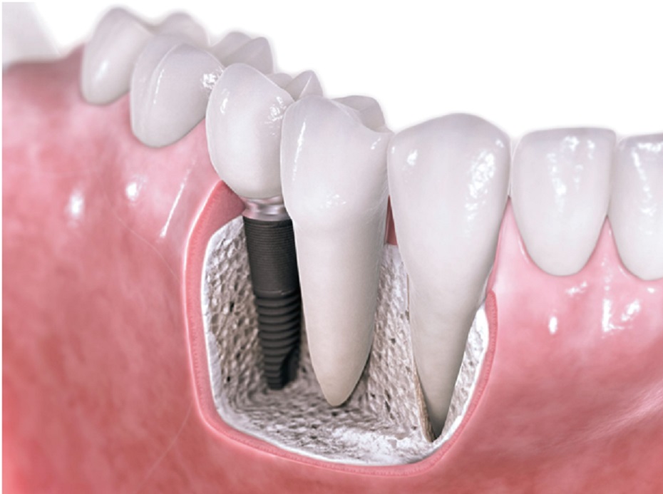 Navigating Periodontal Disease in Dental Implant Treatment