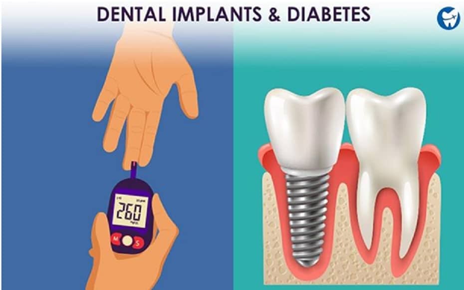 Orchestrating Dental Implants and Diabetes