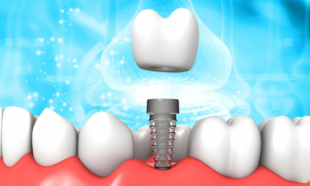 Understanding Dental Crown Materials: From Porcelain to Zirconia