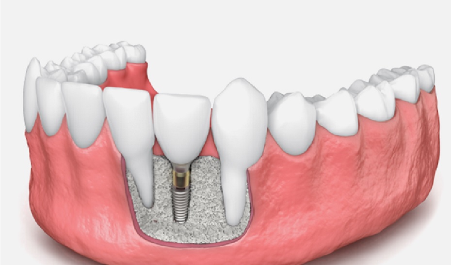 Unlocking the Crucial Role of Bone Grafting in Dental Implant Success