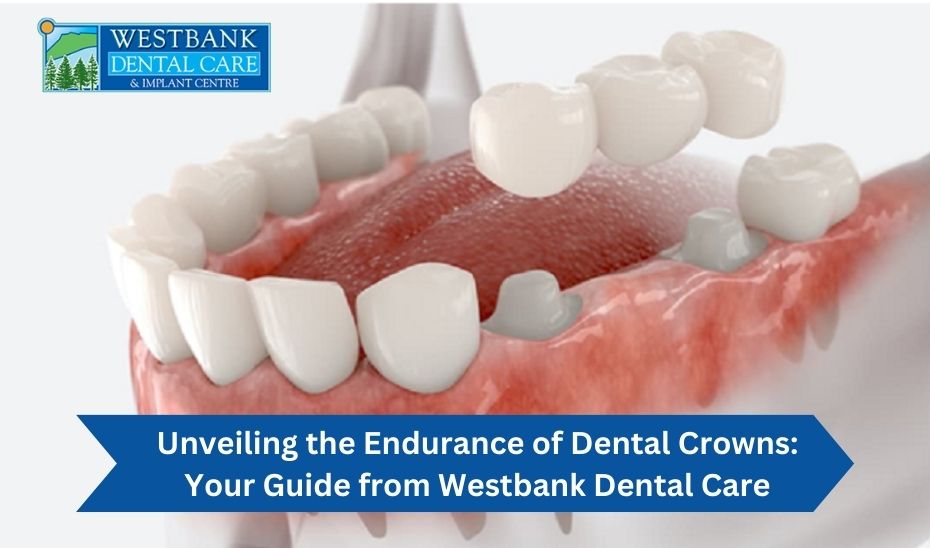 Unveiling the Endurance of Dental Crowns