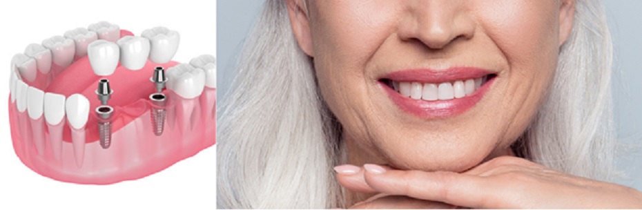 Unveiling the Excellence of Senior Dental Implants